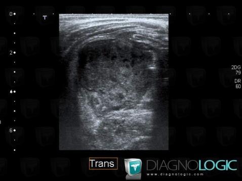 Abscess, Caecum / Appendix, US