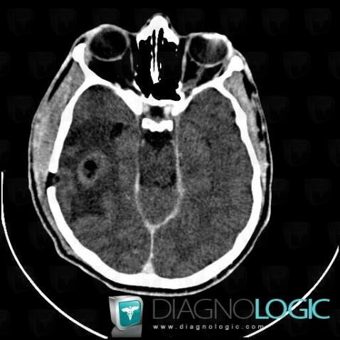 Abscess, Cerebral hemispheres, CT