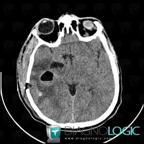 Abscess, Cerebral hemispheres, CT