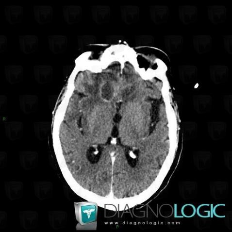 Abscess, Cerebral hemispheres, CT