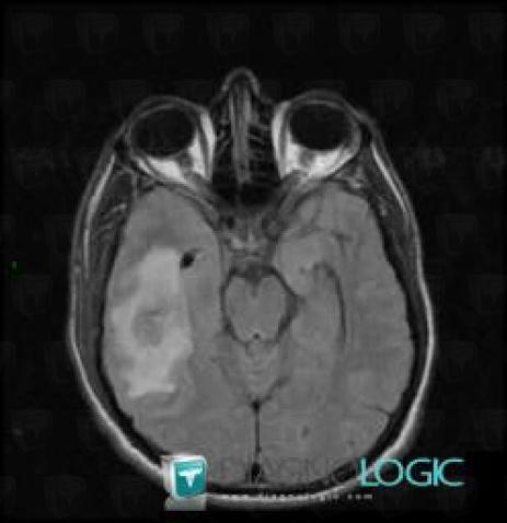 Abscess, Cerebral hemispheres, MRI
