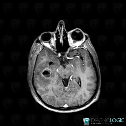 Abscess, Cerebral hemispheres, MRI