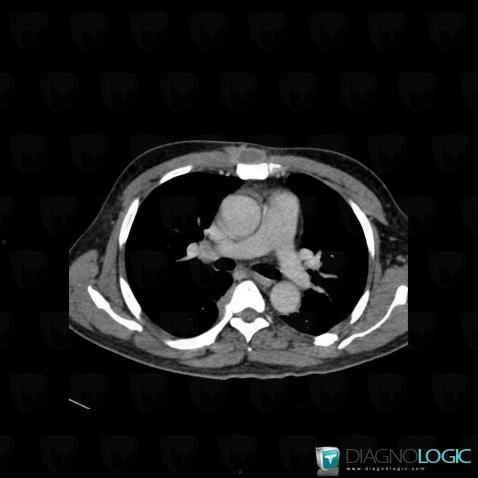 Abscess, Chest wall, CT