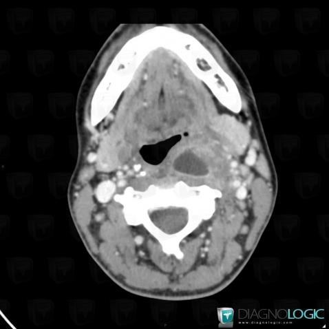 Abscess, Deep facial spaces, CT