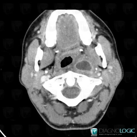 Abscess, Deep facial spaces, CT