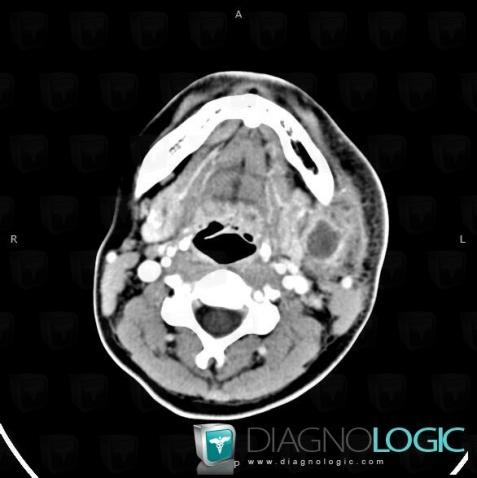 Abscess, Deep facial spaces, CT