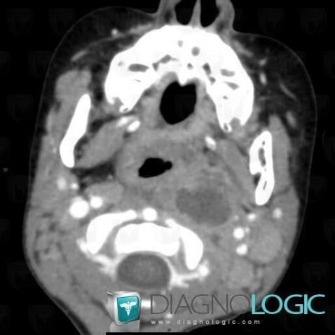 Abscess, Deep facial spaces, CT