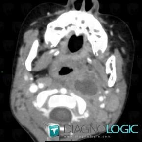 Abscess, Deep facial spaces, CT