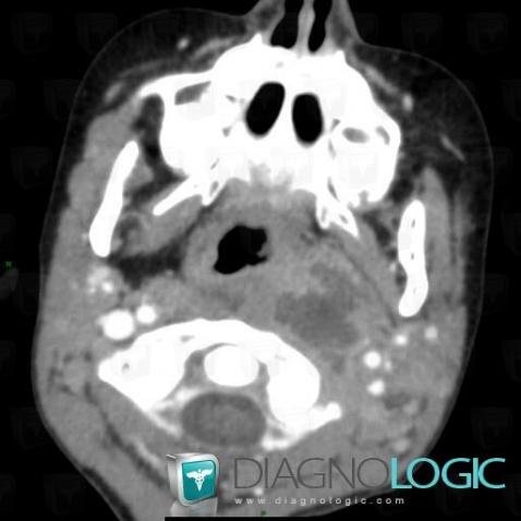 Abscess, Deep facial spaces, CT