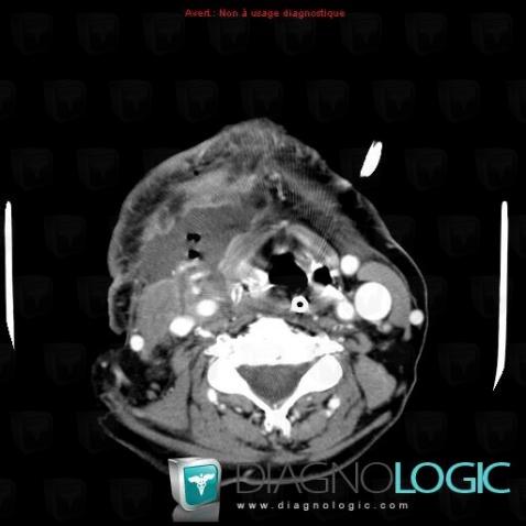 Abscess, Deep facial spaces, CT