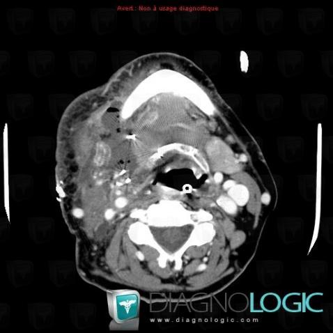 Abscess, Deep facial spaces, CT