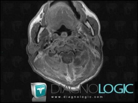 Abscess, Deep facial spaces, MRI