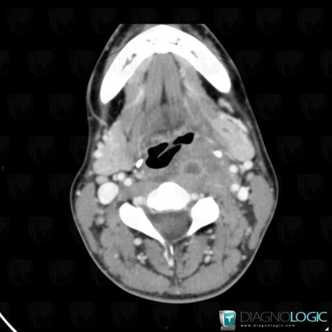 Abscess, Deep neck spaces, CT