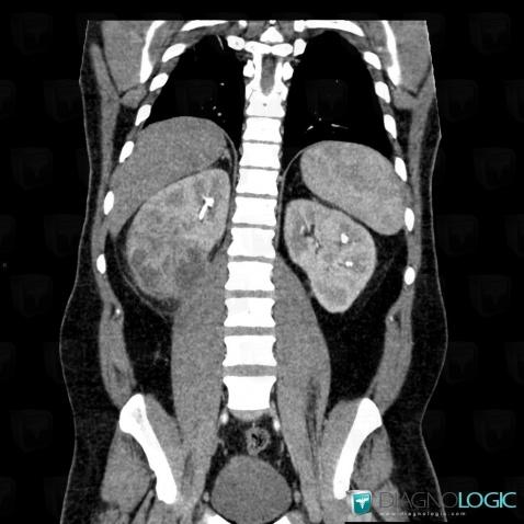 Abscess, Kidney, CT