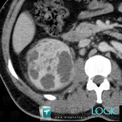 Abscess, Kidney, CT