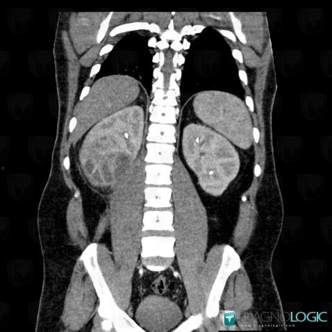 Abscess, Kidney, CT