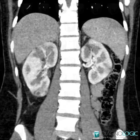 Abscess, Kidney, CT