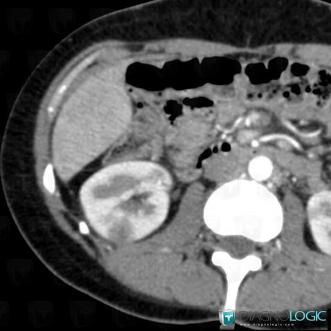 Abscess, Kidney, CT