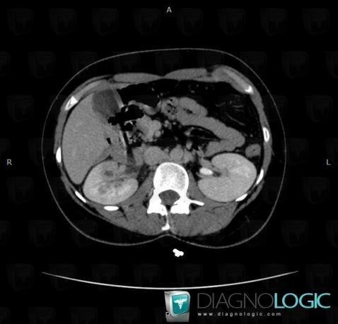 Abscess, Kidney, CT