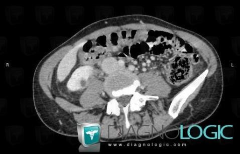 Abscess, Kidney, CT