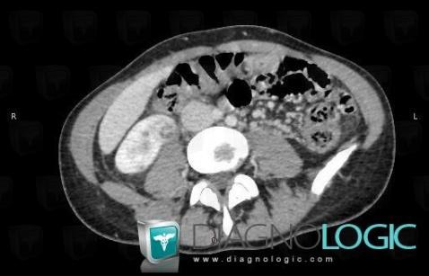 Abscess, Kidney, CT