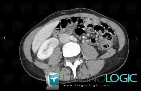 Abscess, Kidney, CT