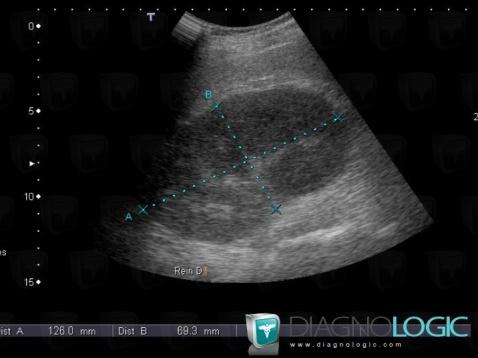 Abscess, Kidney, US