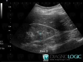 Abscess, Kidney, US