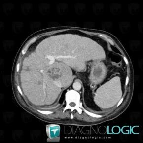 Abscess, Liver, CT
