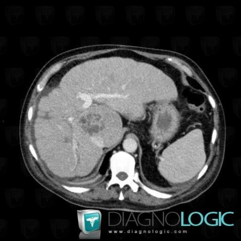 Abscess, Liver, CT