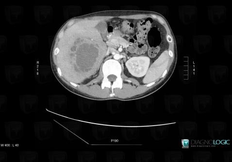 Abscess, Liver, CT