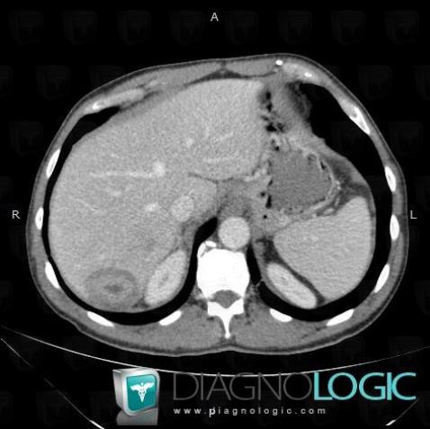 Abscess, Liver, CT