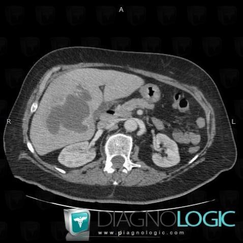 Abscess, Liver, CT