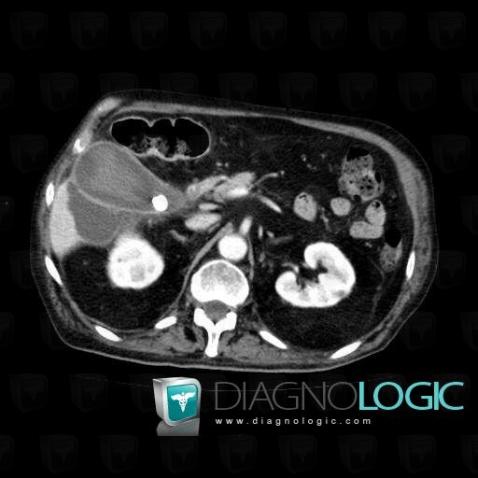 Abscess, Liver, CT