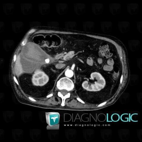 Abscess, Liver, CT