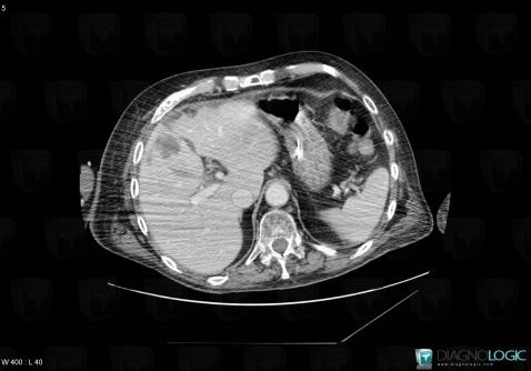 Abscess, Liver, CT