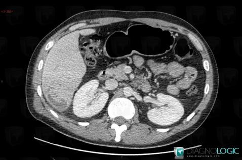 Abscess, Liver, CT