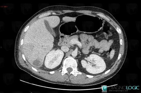 Abscess, Liver, CT