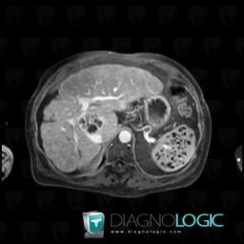 Abscess, Liver, MRI