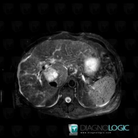 Abscess, Liver, MRI