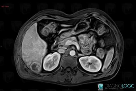 Abscess, Liver, MRI