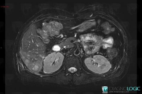 Abscess, Liver, MRI