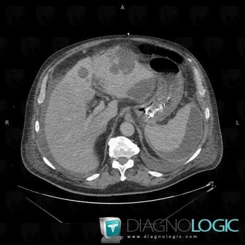 Abscess, Liver, Spleen, CT