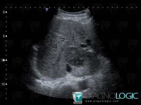 Abscess, Liver, US