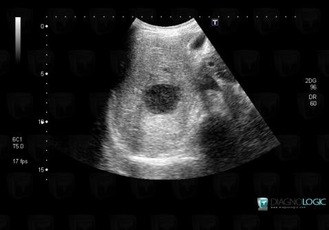 Abscess, Liver, US