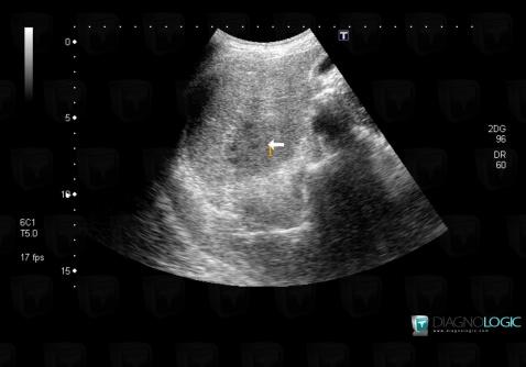 Abscess, Liver, US