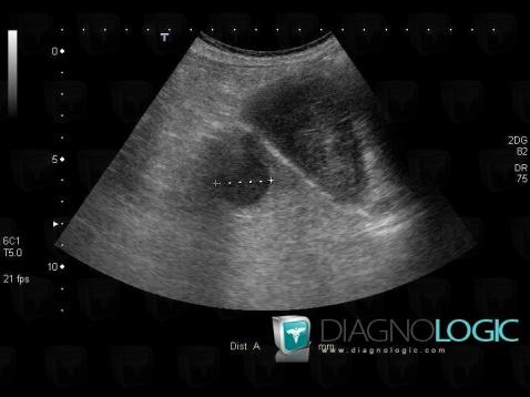 Abscess, Liver, US