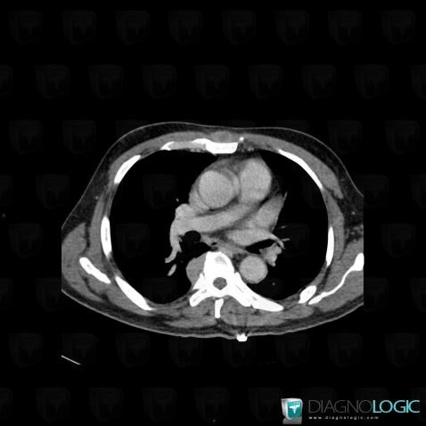 Abscess, Mediastinum, CT