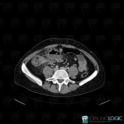 Abscess, Mesentery / Peritoneum, CT