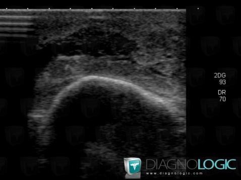 Abscess, Muscles - Forearm, US